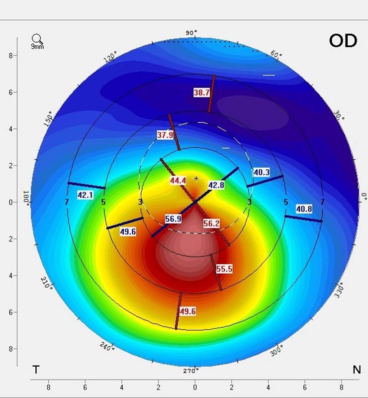 Κερατόκωνος | Οφθαλμιατρεία Καλούδης Μπουζούκης