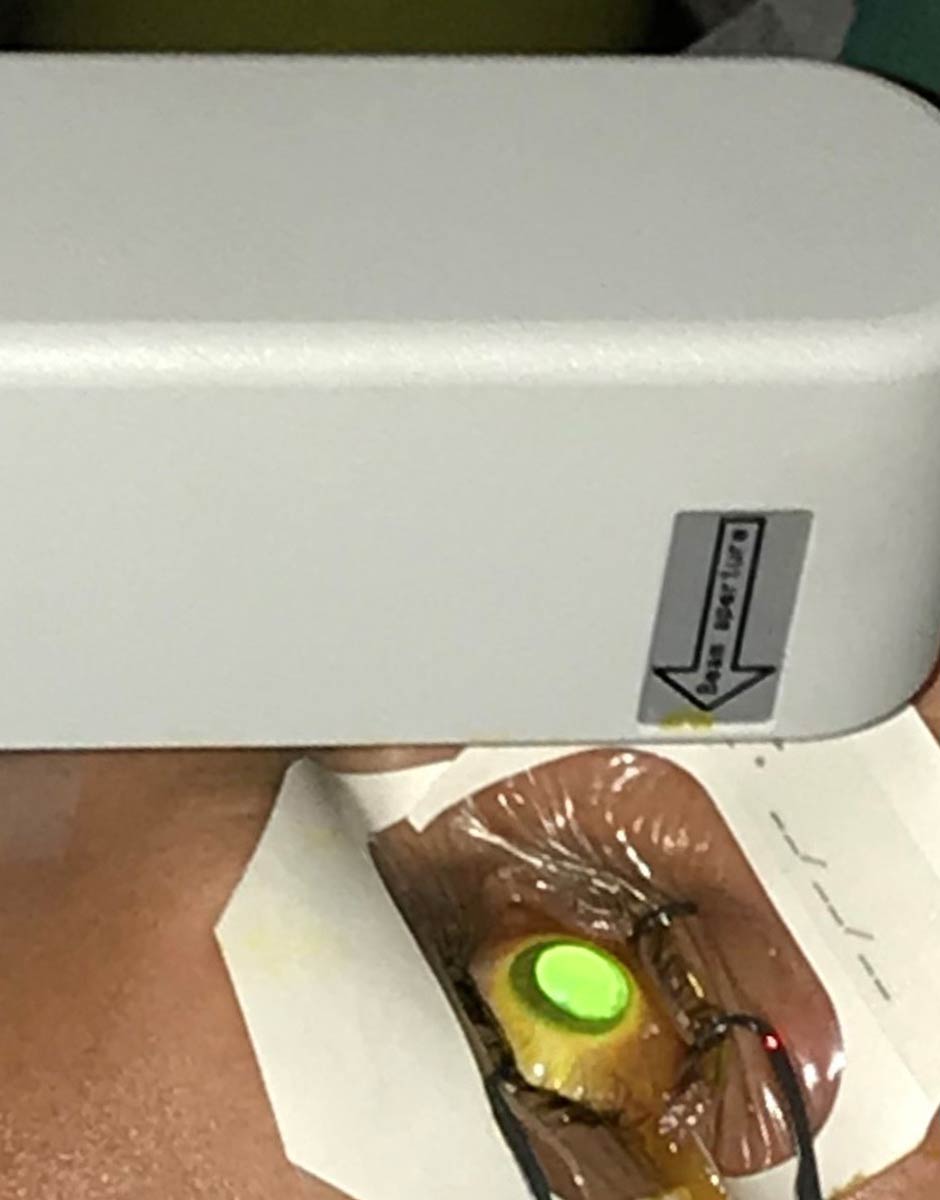 Κερατόκωνος | Οφθαλμιατρεία Καλούδης Μπουζούκης