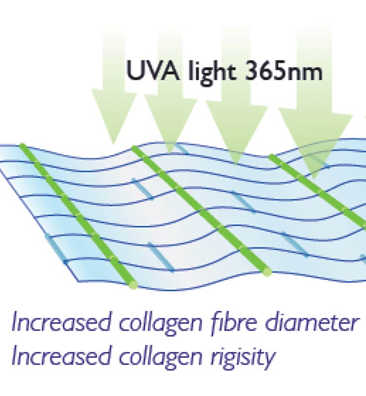 Κερατόκωνος | Οφθαλμιατρεία Καλούδης Μπουζούκης
