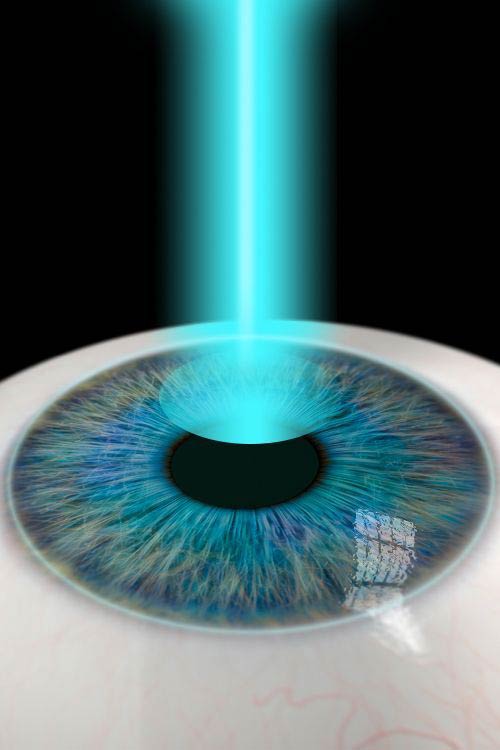 Κερατόκωνος | Οφθαλμιατρεία Καλούδης Μπουζούκης