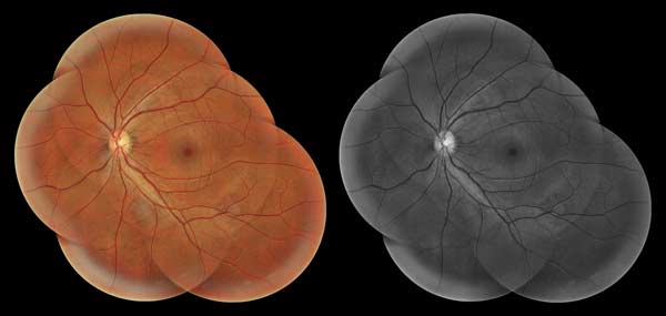 OCT Αγγειογραφία και Φωτογραφία Βυθού | Οφθαλμιατρεία Καλούδης Μπουζούκης