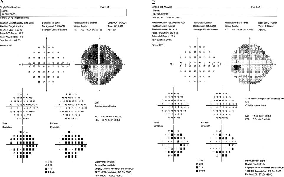 OCT Αγγειογραφία και Φωτογραφία Βυθού | Οφθαλμιατρεία Καλούδης Μπουζούκης