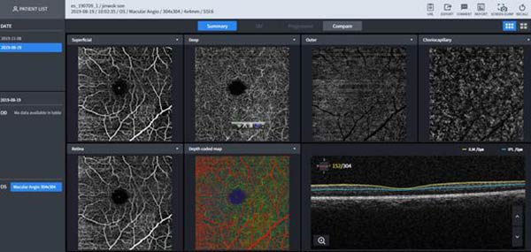 OCT Αγγειογραφία και Φωτογραφία Βυθού | Οφθαλμιατρεία Καλούδης Μπουζούκης